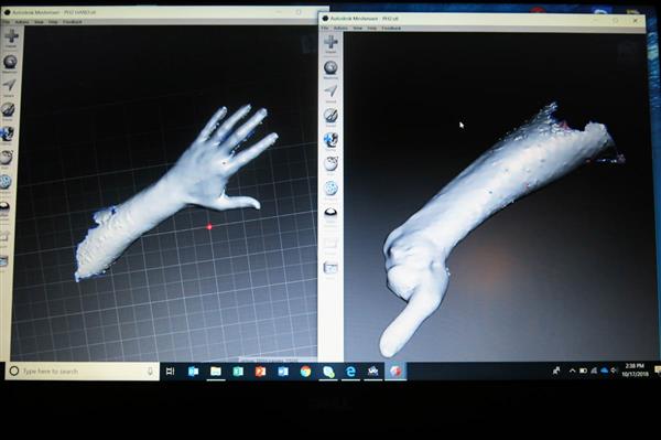 约旦安曼无国界医生中东冲突受害者提供3D打印假肢